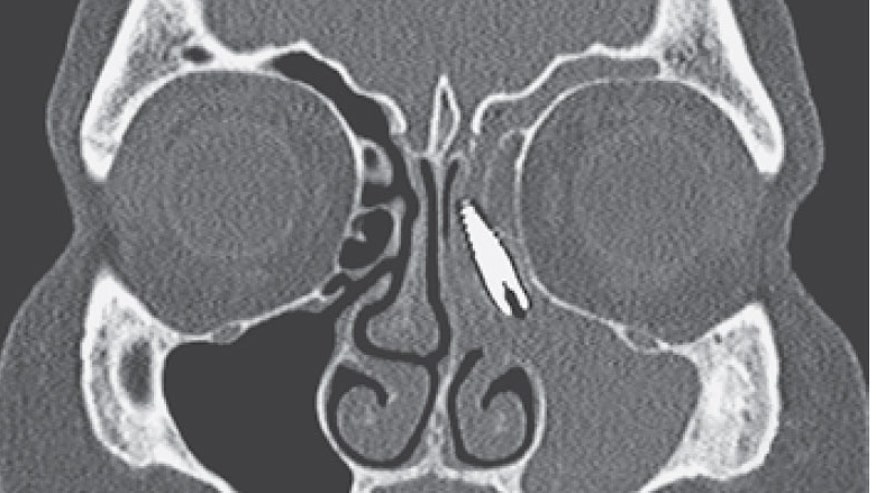 Dental implant livescience.jpg